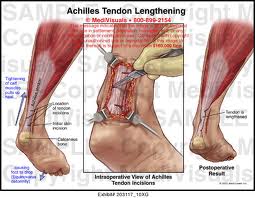 lengthening tendon | goodthoughtsgoodlives lengthening tendon