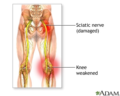 sciatica | goodthoughtsgoodlives sciatica